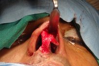 Open rhinoplasty for cleft lip nose deformity