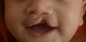 Incomplete unilateral cleft of the lip