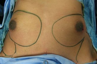 Before liposuction for bilateral gynecomastia