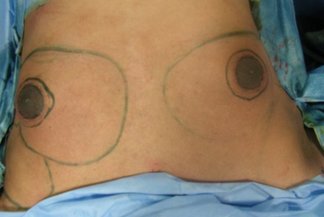 After liposuction for bilateral gynecomastia