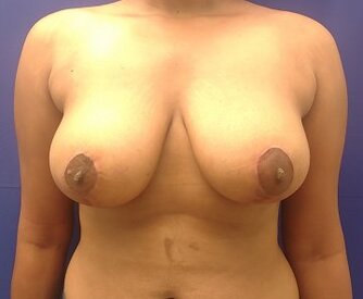 After breast reduction (medial pedicle technique)