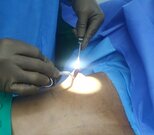 4. Gland removal