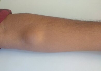 Lipoma of forearm