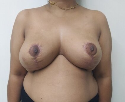 After secondary breast reduction (2 months post-op)