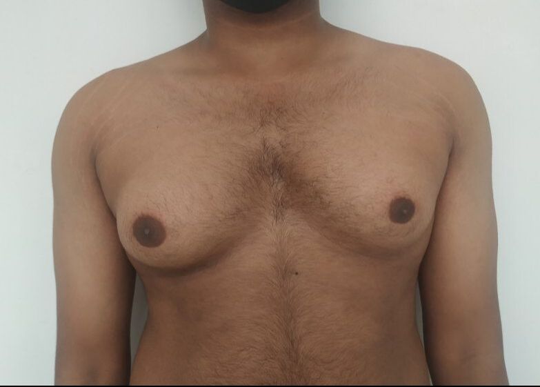 Before: Gynecomastia in an individual with a low IMF (inframammary fold)