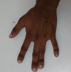 Simple syndactyly involving the soft tissues