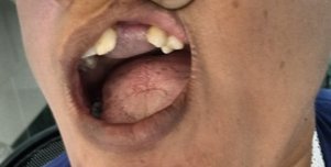 After fistula correction with a tongue flap