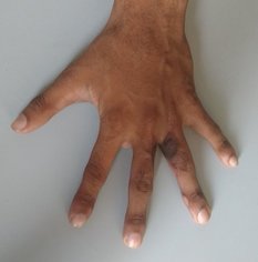 Syndactyly treated with local flaps and full thickness skin grafts