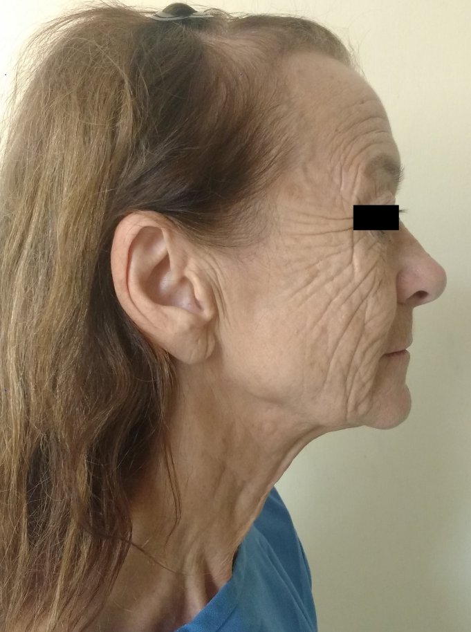 Before facelift and neck lift 