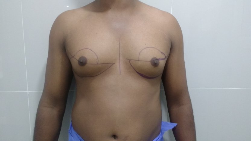 2. Preoperative markings to highlight the muscle, fat and gland