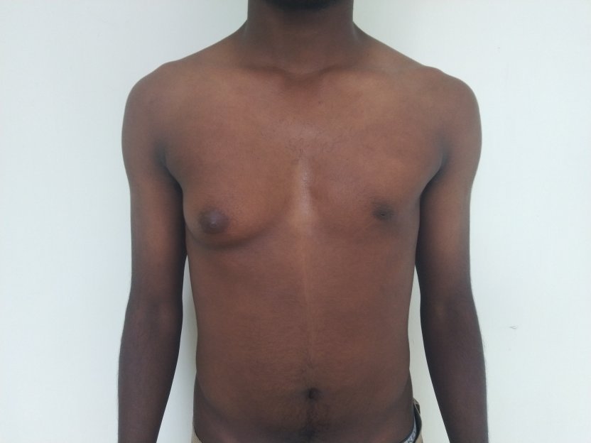 Before: Marked asymmetry with gynecomastia on right greater than left 