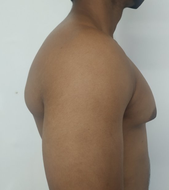 Before: Gynecomastia in a muscular individual without lipodystrophy