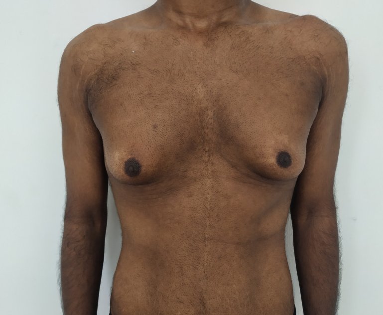Before: Gynecomastia in an individual with massive weight loss and excess skin