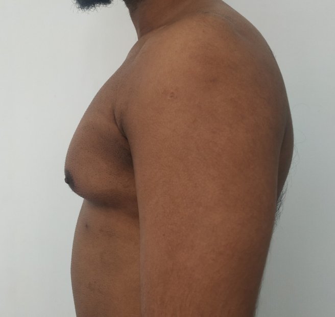 Before: Gynecomastia in an individual with mild lipodystrophy 