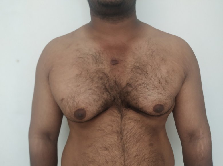 Before: Gynecomastia with preoperative asymmetry, ptosis, and a keloidal scarring tendency 