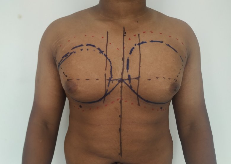 Preoperative markings 