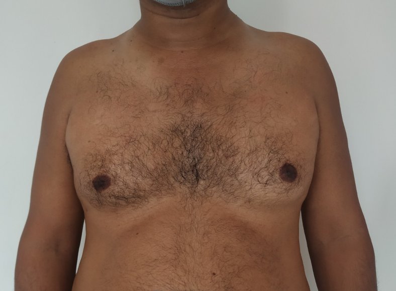 Before: Gynecomastia in a middle aged male with pendulous abdomen