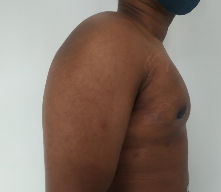 After: Early postoperative appearance at 11 days with swelling (temporary) and sutures in situ