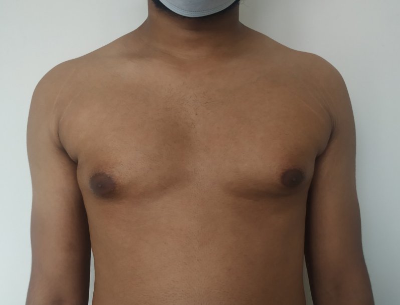 Before: Gynecomastia with moderate lipodystrophy