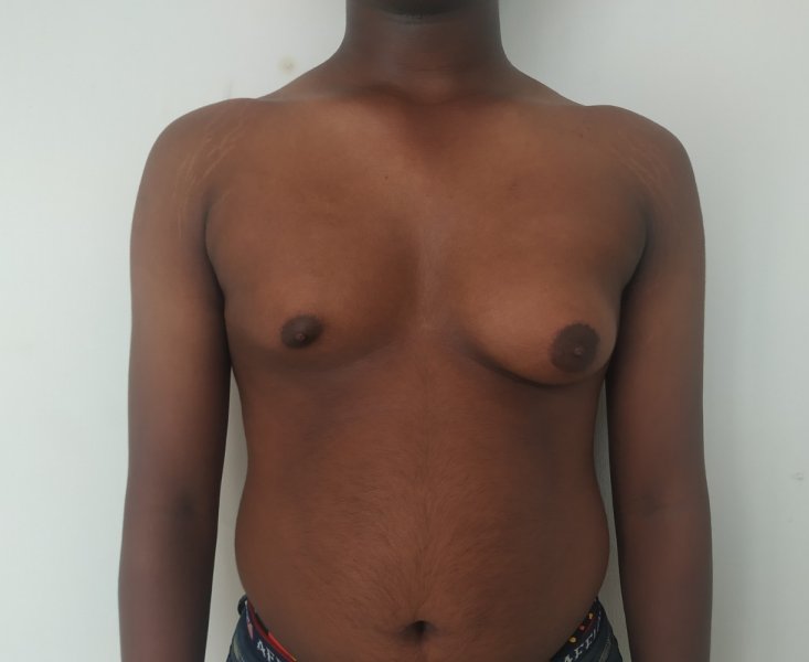 Before:  Glandular asymmetry of the breasts