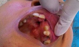Fistula (abnormal communication between oral and nasal cavities) of the palate