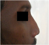 Postoperative image after open rhinoplasty with primary bone grafting