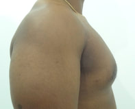 after enlarged male breast correction
