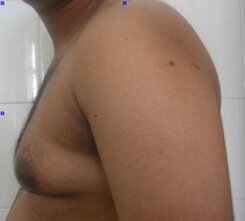 Gynecomastia with excess glandular and fatty tissues with lax skin
