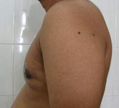 Gynecomastia treated with liposuction, direct excision of gland and dough-nut excision of skin