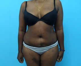 Abdominoplasty after - frontal view 