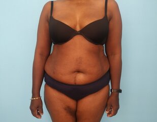 Abdominoplasty before - frontal view 