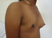 Hypomastia of the right breast