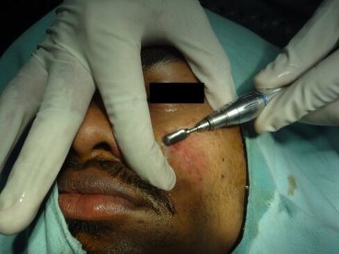 Dermabrasion for shallow scars of the cheek