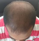 After conservative management with medicines and topical minoxidil. 