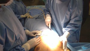 Liposuction (Suction assisted lipectomy)