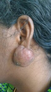 Keloid of the earlobe