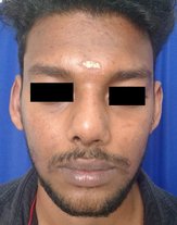 After: revision rhinoplasty done with dorsal, spreader, lateral wall and septal extension cartilage grafts and lateral and medial osteotomies.