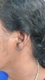 Keloid treated with surgery and external radiotherapy