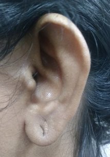 Preoperative picture showing a prominent ear due to weak antihelical fold