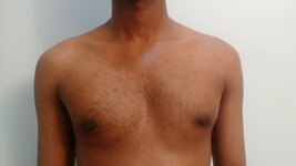 Post-op view of the same patient treated with liposuction and gland excision. 