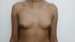 Before breast implant undertaken as part of SRS