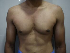 Before: Gynecomastia in an individual with asymmetry of the underlying muscles (left pec major is bulkier compared to the right).