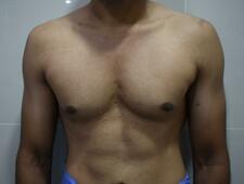 Left pectoralis major (muscle) is more hypertrophied compared to the right. 