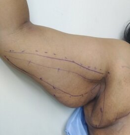 Patient had previously undergone liposuction elsewhere 6 years back. She wanted improvement of the loose folds of arm skin. Image shows preoperative markings of brachioplasty.