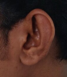 Prominent left ear with attenuated antihelix