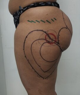 Liposuction markings | lateral view