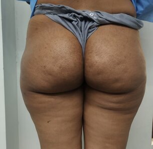 Early postoperative (3 weeks) image of liposuction of buttocks and lateral thighs