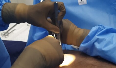 Gynecomastia correction under local anesthesia