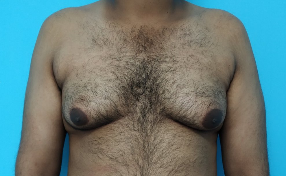 Excess skin in an individual presenting with gynecomastia 