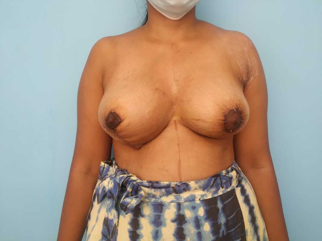 Early postoperative image with reduction mammaplasty of the right breast and areolar reduction, and fat grafting of the left breast 